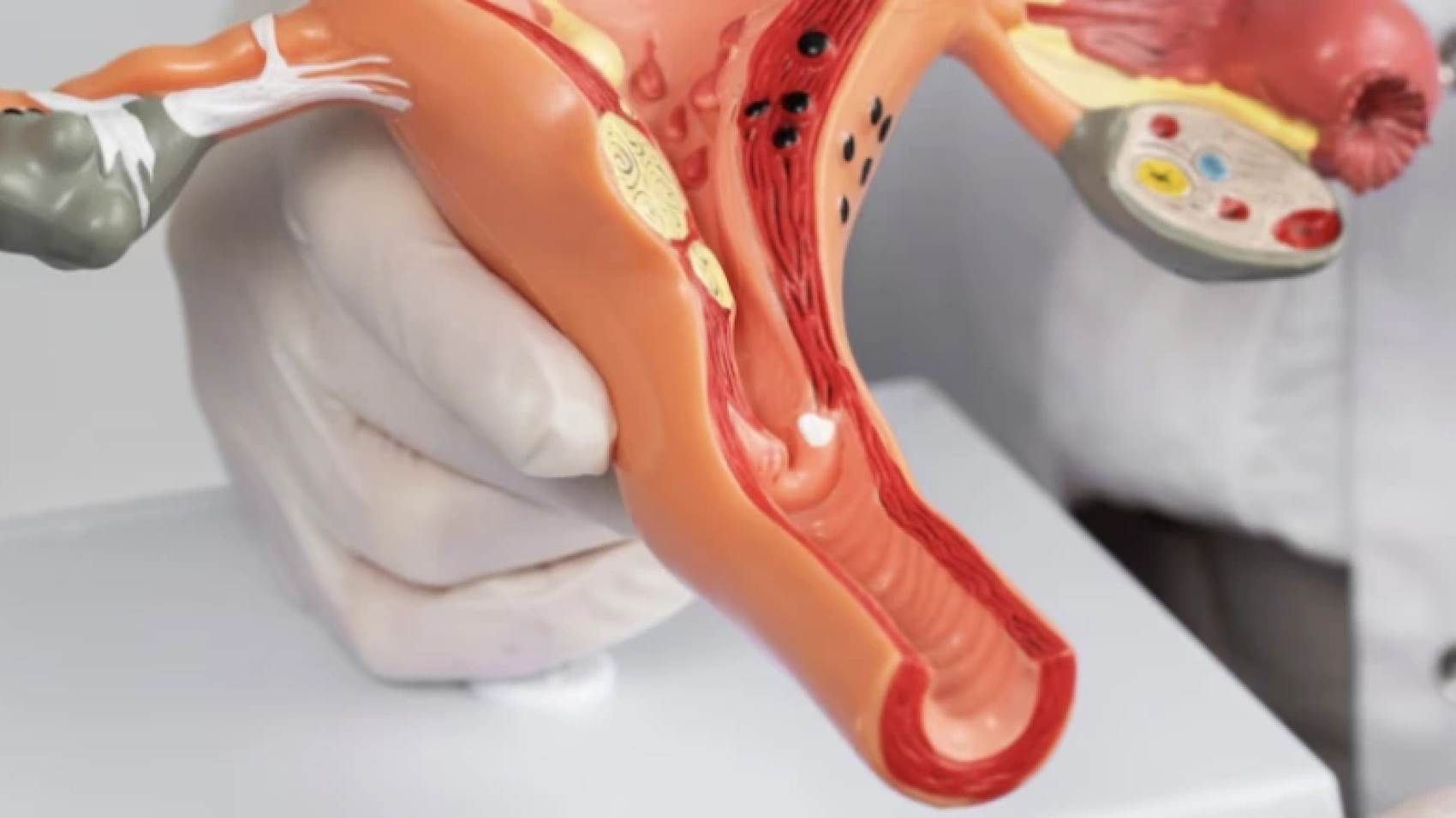post-endometriose