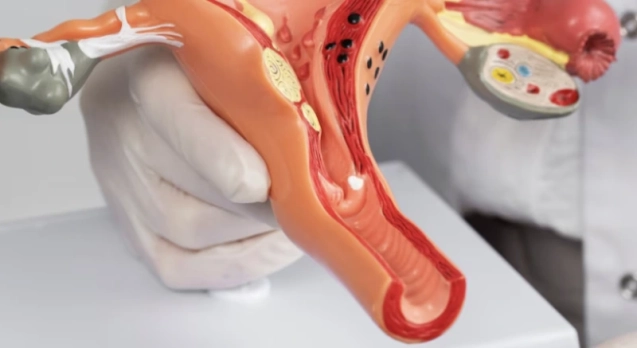 post-endometriose